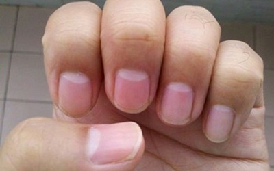 Warna Pangkal Kuku Tunjukkan Kondisi Kesehatan Anda