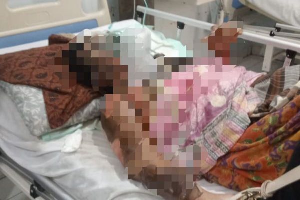 Alasan Cemburu, Suami di Inhu Riau Bakar Tubuh Istri