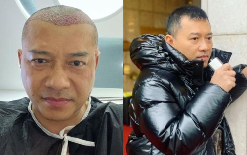 Anang Hermansyah Jalani Transplantasi Rambut di Turki 