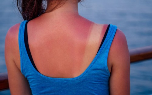 Kulit Terbakar Sinar Matahari dan Cara Mengatasinya