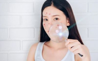 Cara Menghilangkan Jerawat Menggunakan Cuka Apel