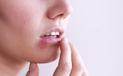 Penyakit Herpes, Penyebab dan Cara Mencegahnya 