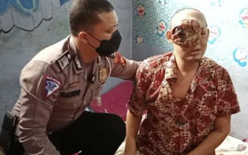 Tumor Ganas Hampir Menutup Wajah Arianto, Polisi Carikan Pendonasi