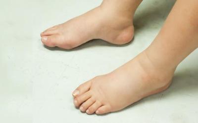 Di Kabupaten Bengkalis Ditemukan 3 Penderita Kaki Gajah