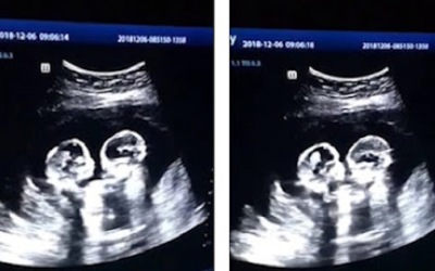 Video Viral, Kembar Identik 'Berkelahi' di Rahim Saat USG