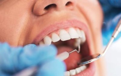 Begini Cara Mencegah Menumpuknya Karang Gigi