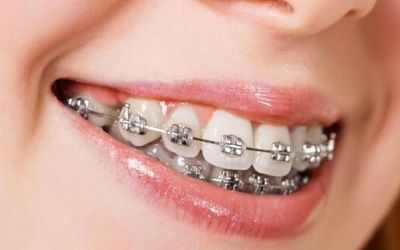 Ini Hukum Pasang Kawat Gigi Dalam Islam