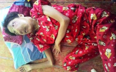 Yusmaneti Penderita Tumor Ganas, Butuh Perhatian Pemerintah