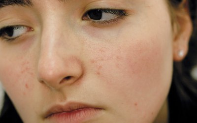Peneliti: Wajah Berjerawat Lebih Awet Muda