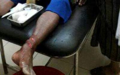 Mahadar Pingsang Setelah Diterkam Buaya Sungai Rokan