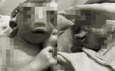 Bayi Kepala Separuh di India Ini Hanya Bertahan Hidup Sesaat